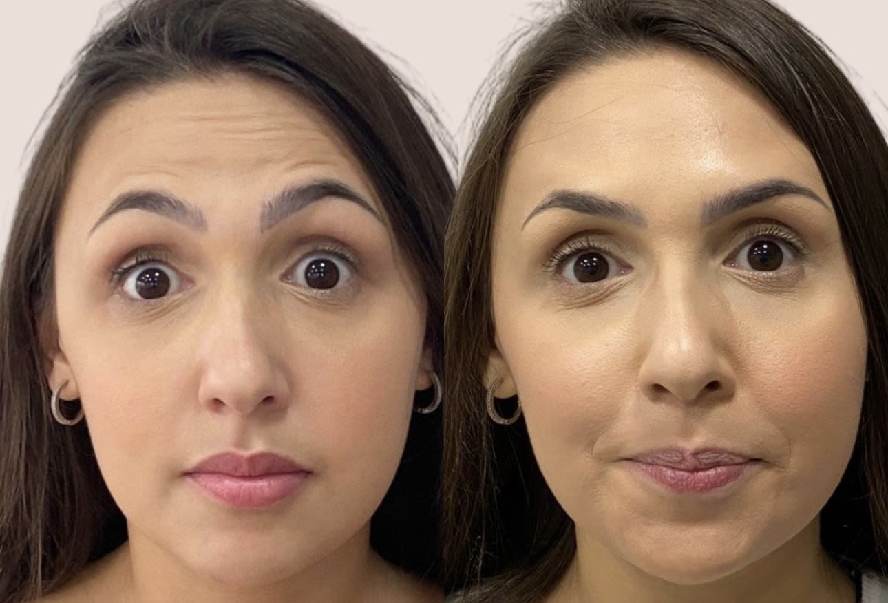 Botox 1