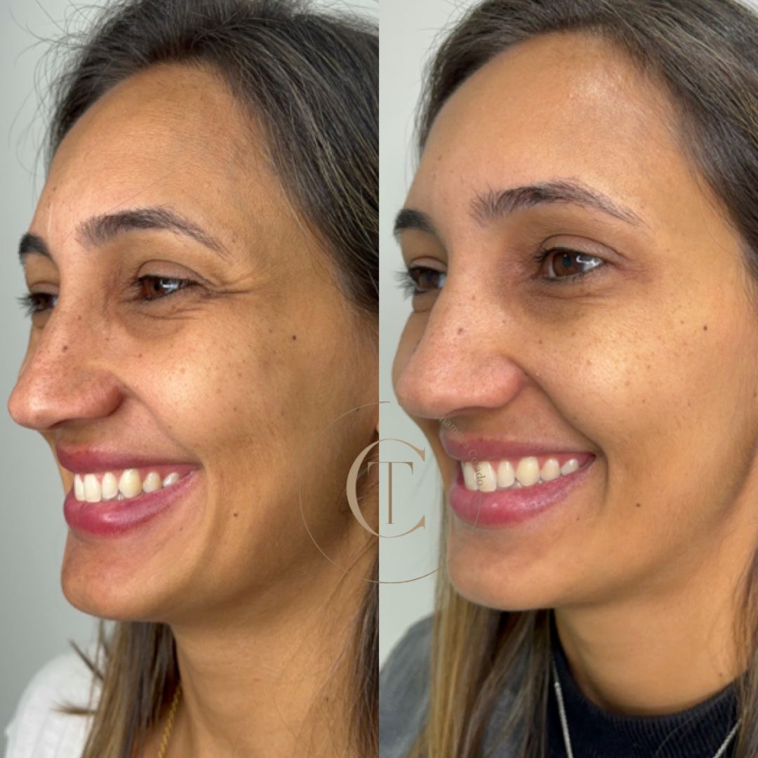 Botox 2
